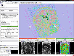 tracts and glyphs view - +90° rotation of measurement frame