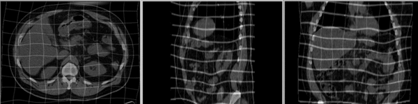 Example BSpline deformation of a liver CT dataset. Superimposed gridlines indicate extent of deformation applied.