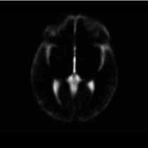 EMSegmenter MRI-Human-Brain CSF 420x420.png