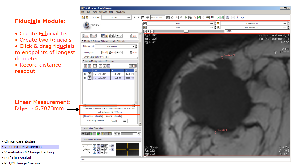 measuring pre-TX tumor with fiducials, longest dimension