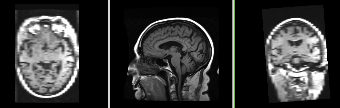 MRI-Human-Brain-HIPR-T1Flair.png