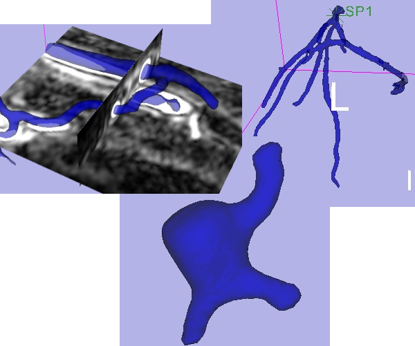 thumb Vessels of an arm, a coronary tree, a cerebral aneurysm segmented using the VMTKLevelSetSegmentation module