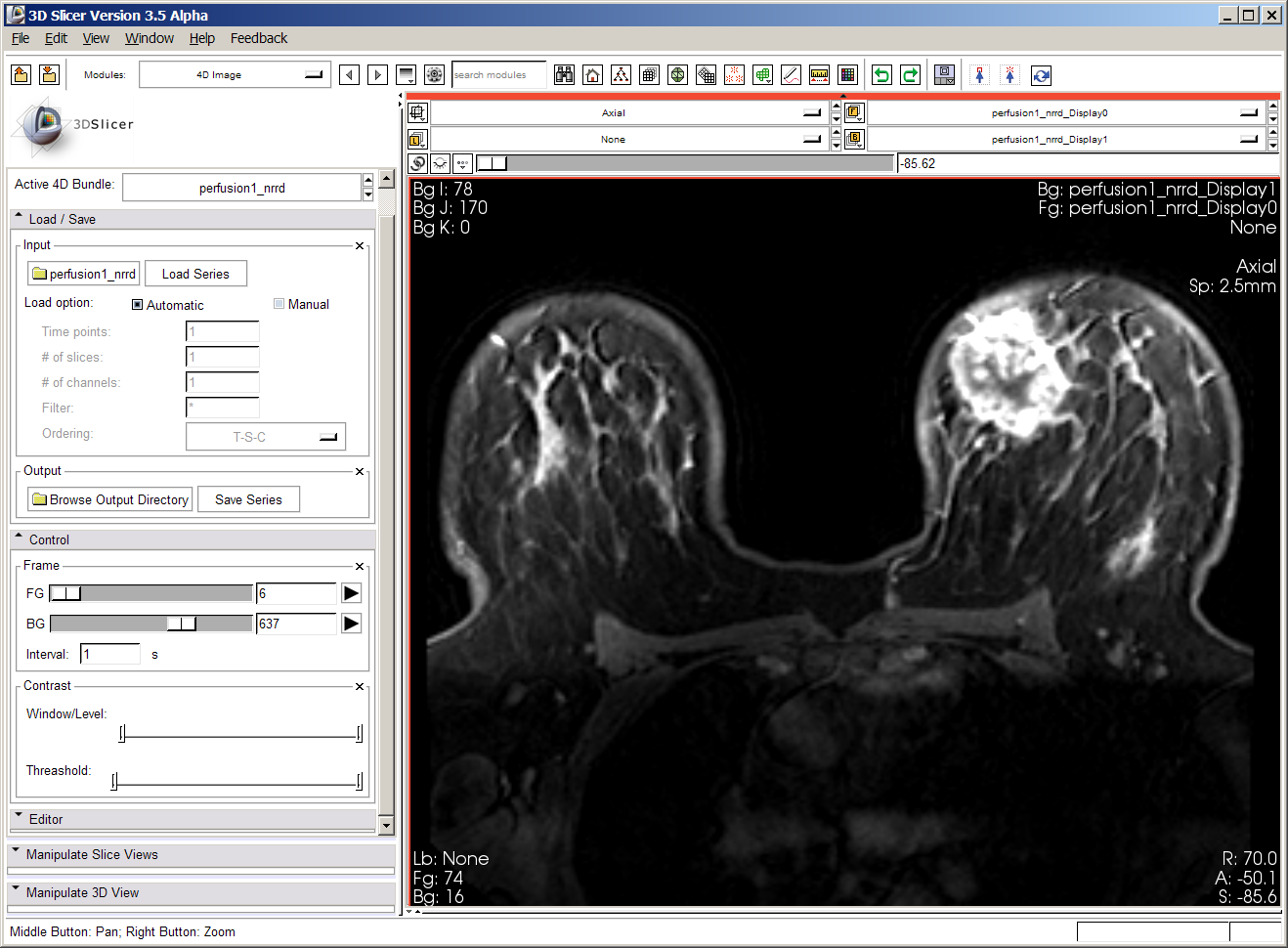 BCAnalysis Perfusion1.png