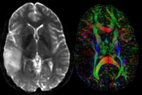 this is the DTI tensor image, in the same orientation as the DTI Baseline