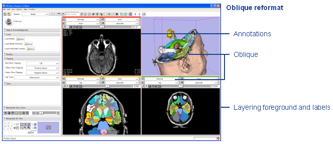File:Annotated Oblique reformat.png
