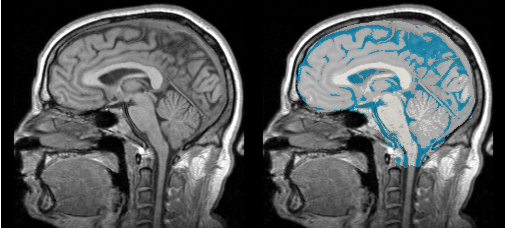 MRI-Human-Brain BeforeAfter.png