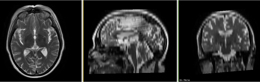 MRI-Human-Brain-HIPR-T2FSE.png