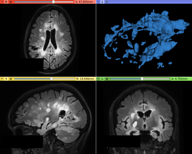 File:T2FLAIR afterContrast.png