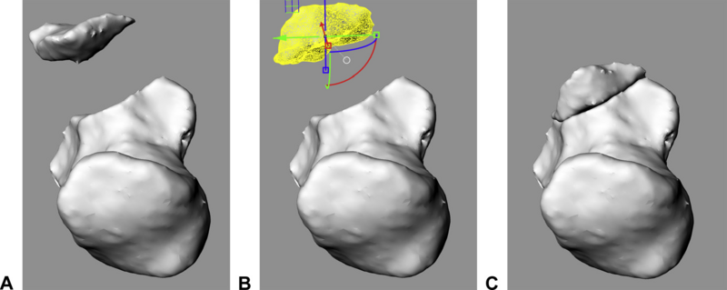 File:Mellema-JHandSurgAm2014-fig1.png