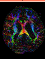 this is the DTI tensor image, in the same orientation as the DTI Baseline