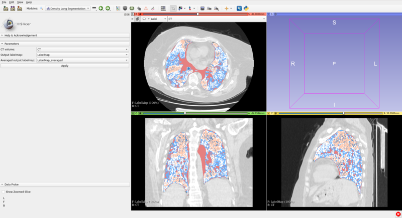 File:LungDensitySegmentation screenshot.png