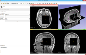 Documentation/4.5/Extensions/VolumeClip - Slicer Wiki