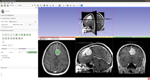 KSliceInitMeningioma.png