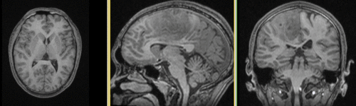 Registered DTI superimposed on FLAIR