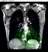 RegLib C46: 2D cine MRI of breathing cycle