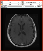 EMSegmentRev PETCT A.png