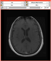 EMSegmentRev PETCT A.png