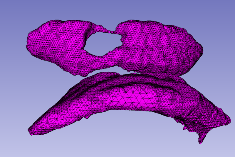 File:Ventricles after.jpg
