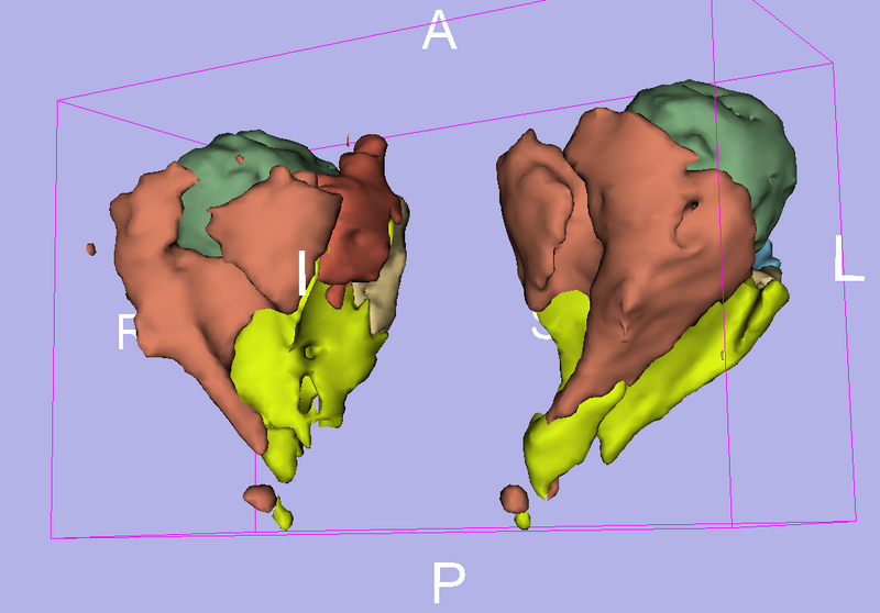 File:EMS Result HumanEyeCase03.png