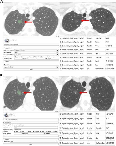 File:Digumarthy-Cancer Imaging. 2019-fig3.jpg