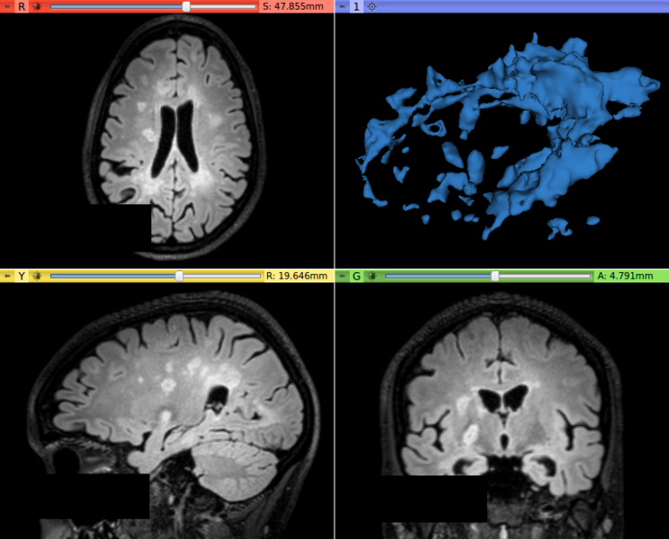 File:T2FLAIR beforeContrast.png