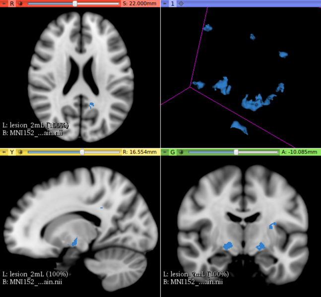 File:LesionLoad 2mL.png