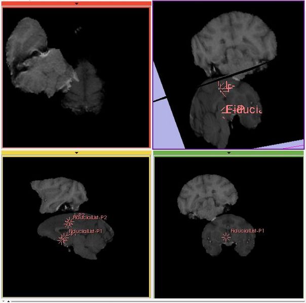 File:Fiducial registration before.jpg