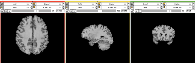 EMS LesionExp T1.png