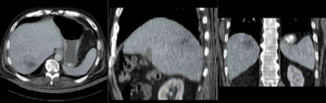 Color overlay of registered MRI onto CT, illustrating the fusion: MRI soft tissue contrast shows substructures & vasculature invisible on the CT