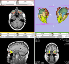 EMS Result HumanEye MR Head.png