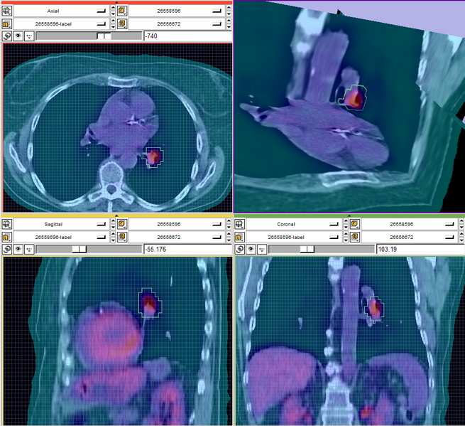 File:PETCTInSlicer1.png