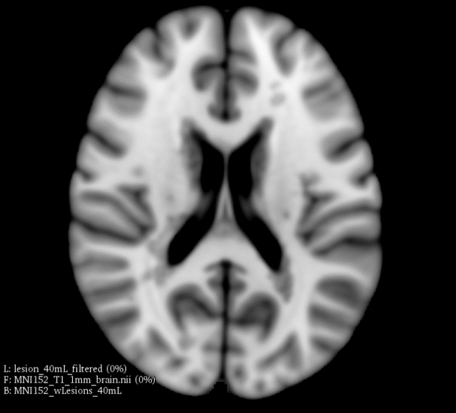 File:LesionMRI-gif.png