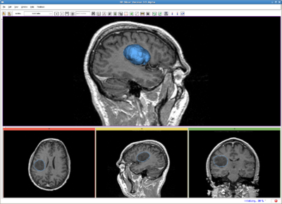 RSS brain tumor result