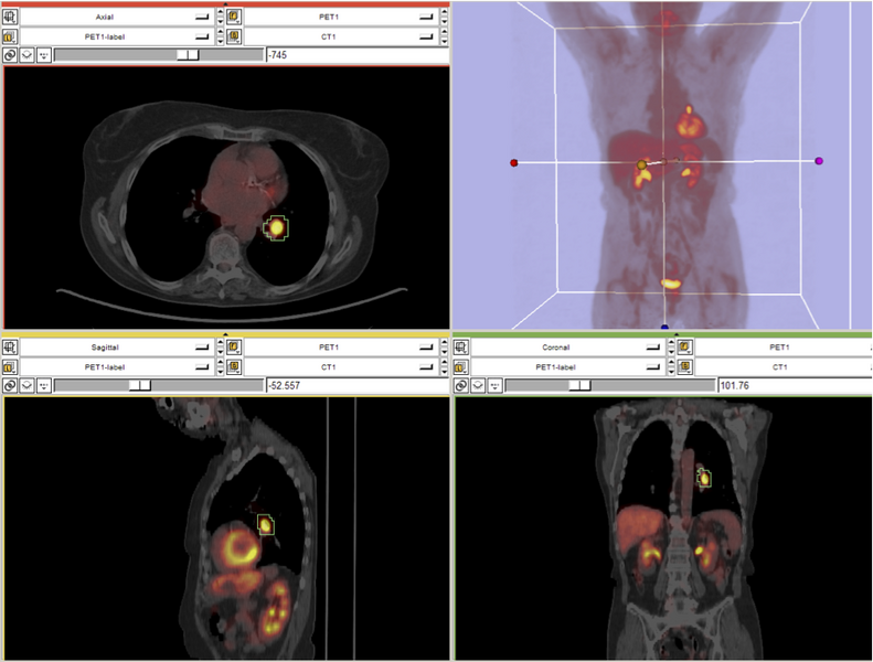 File:PETCTFusionBig.png