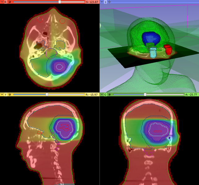 File:SlicerRT0.8 EntLoaded Beams ThresholdedDose.png