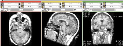 Modules:ThresholdImage-Documentation-3.6 - Slicer Wiki