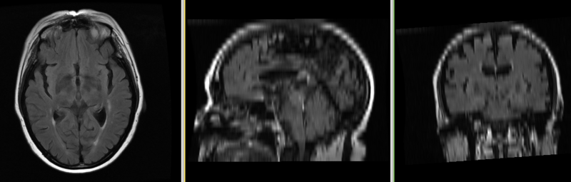 File:MRI-Human-Brain-HIPR-T2Flair.png