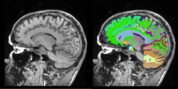 MRIHumanBrainFullParcellation before after.png