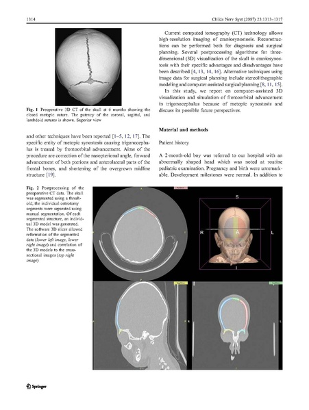 File:Rodt-ChildsNervSyst2007.pdf
