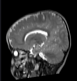 this is the moving MR image, to be aligned with the reference on the left