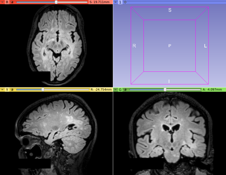 File:T2FLAIR patient.png