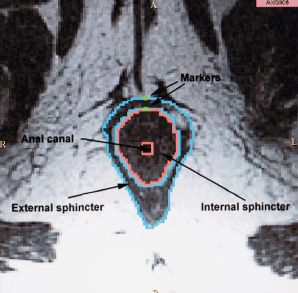 File:Cornella-AJOG2003-fig2.png