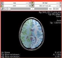 EmSegment PETCT 2.png