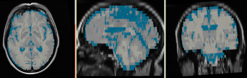 File:MRI-Human-Brain-HIPR-T2Flair map.png