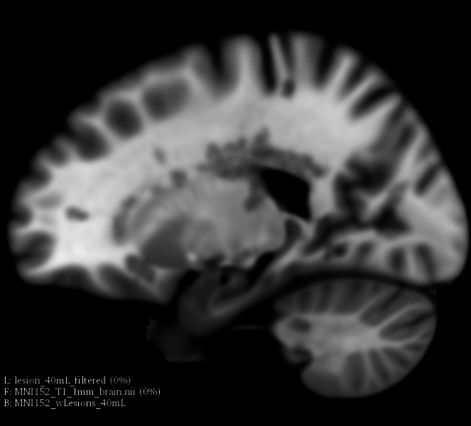 File:MNI152 lesionload40mL sag.png