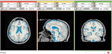 EMS HIVStudy Segmentation.png