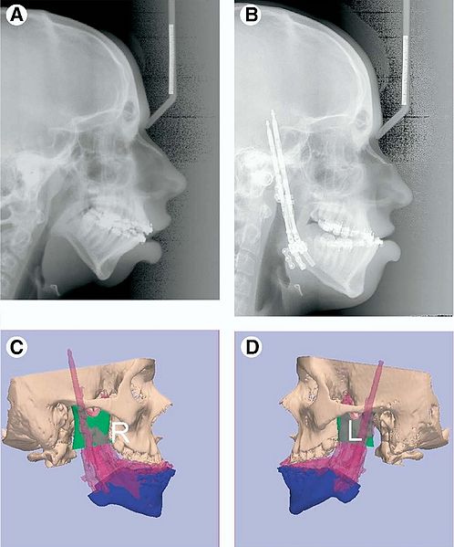 File:Kaban-JOralMaxillofacSurg2009-fig7.jpg