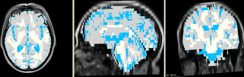 File:MRI-Human-Brain-HIPR-T2FSE map.png