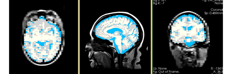 File:MRI-Human-Brain-HIPR-T1Flair map.png