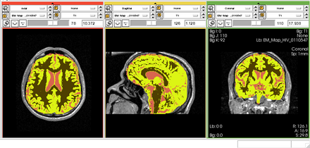 EMS HIVStudy Segmentation Auto.png